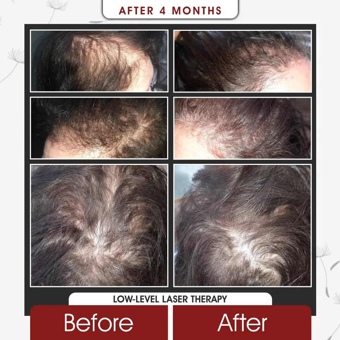 Low Level Laser Therapy After 4 Months