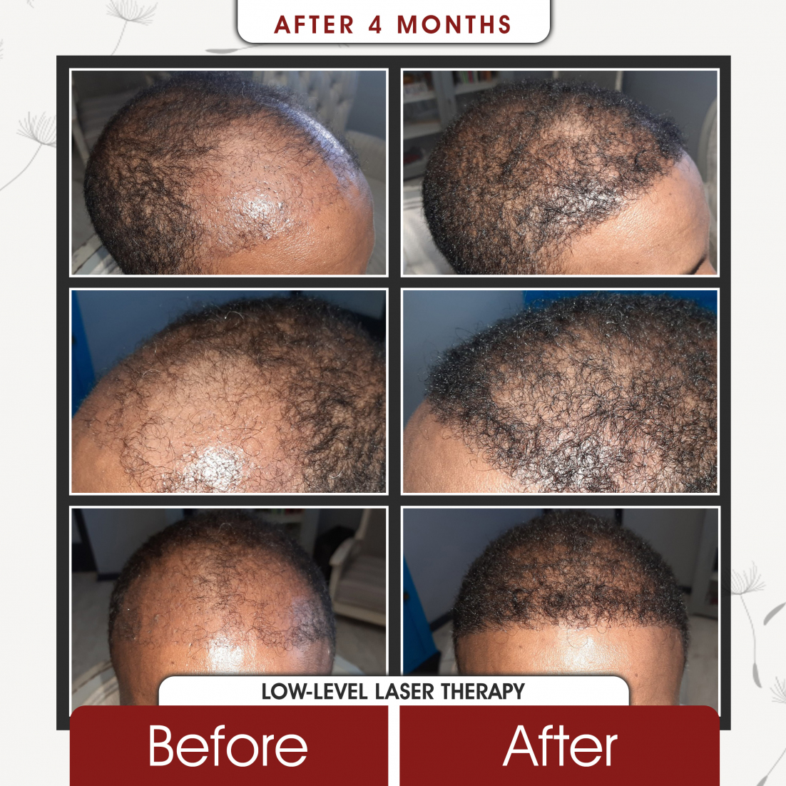 Low Level Laser Therapy After 4 Months