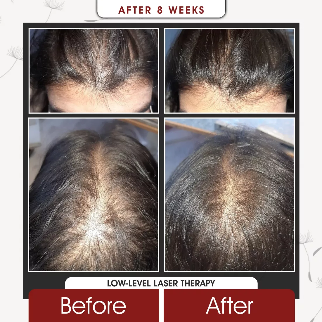 Low Level Laser Therapy After 8 Weeks