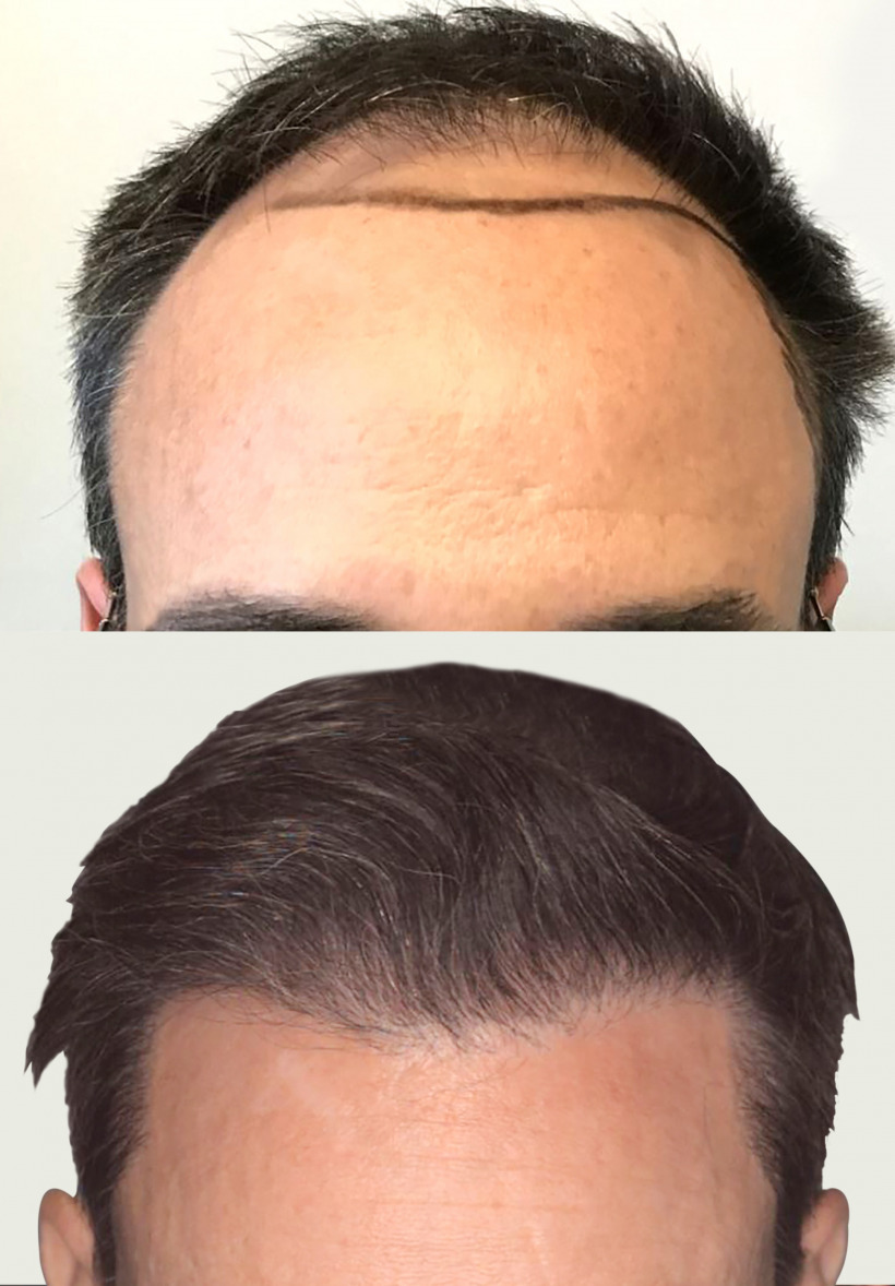Follicular Unit Extraction hair restoration procedure