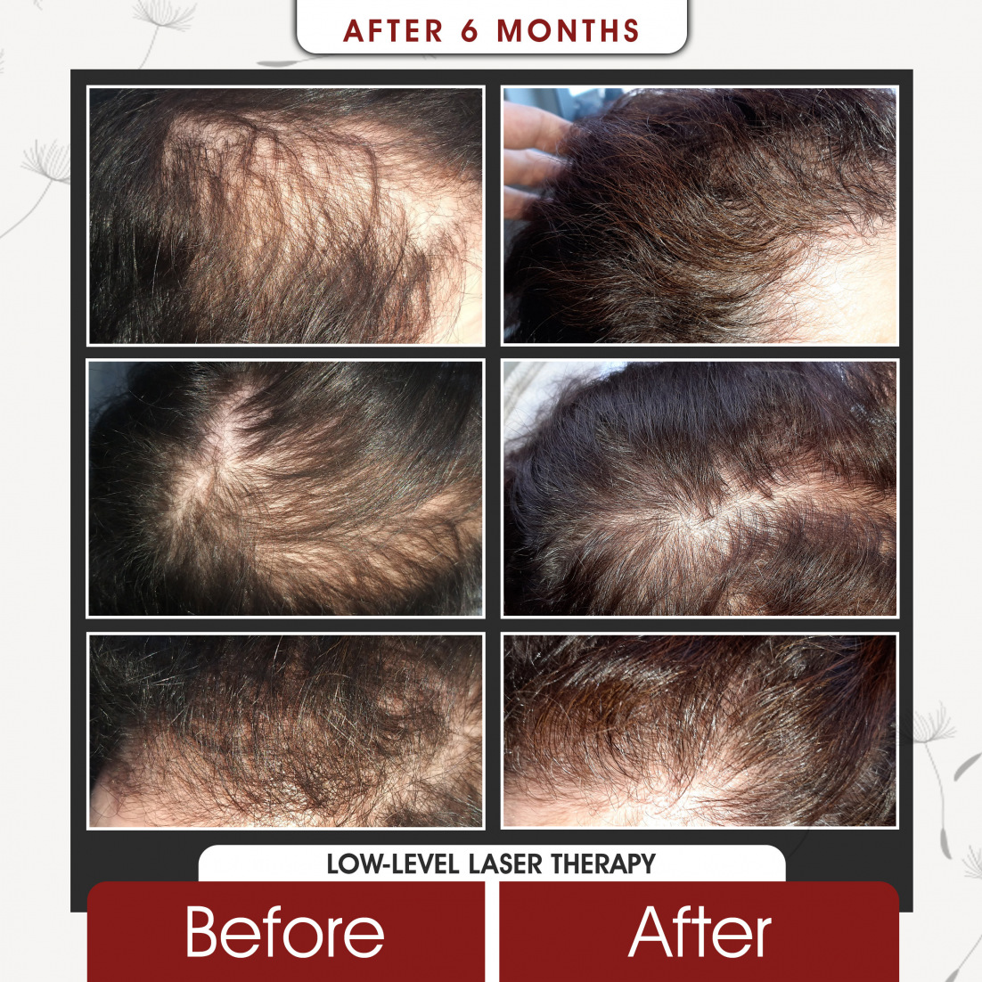 Low Level Laser Therapy After 6 Months