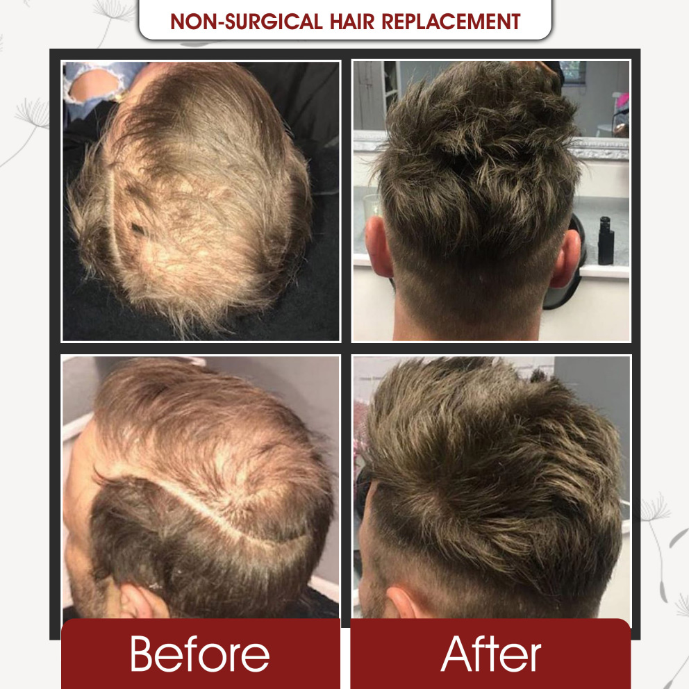 Natural looking hair replacement results at Grace Follicles