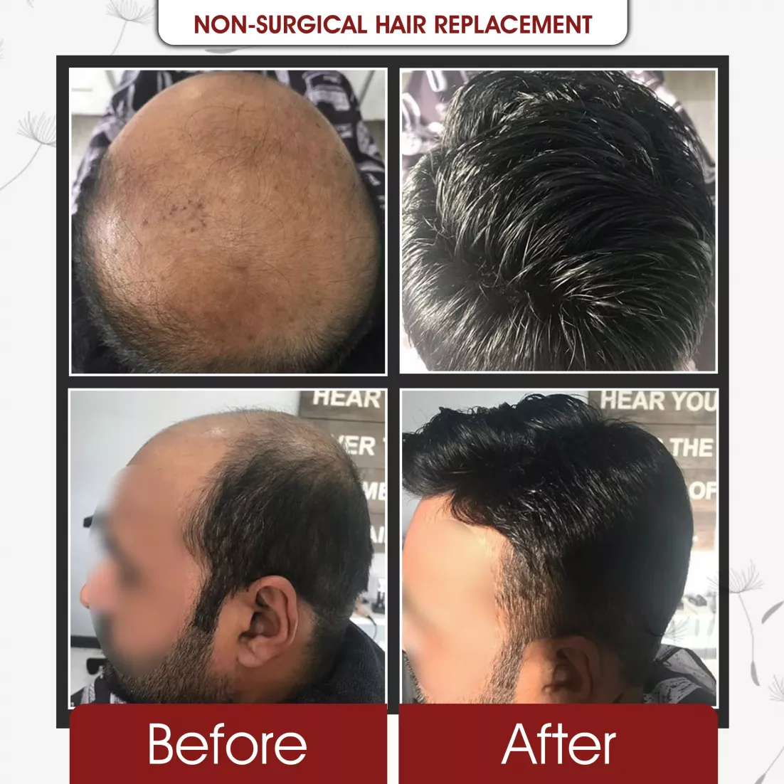 Non Surgical Hair Replcement
