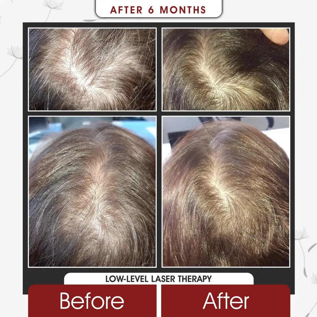 Low Level Laser Therapy After 6 Months
