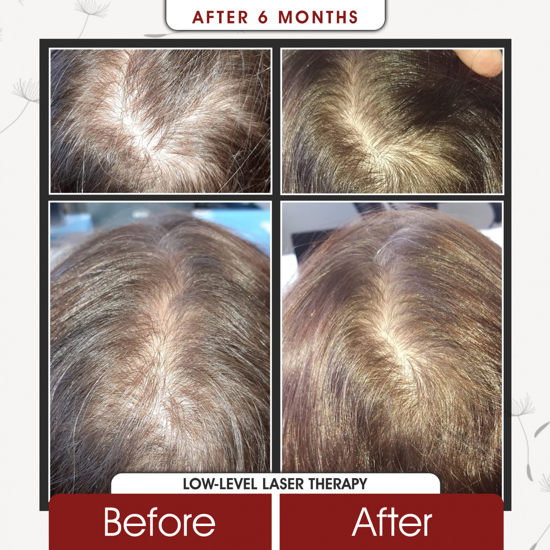 Low Level Laser Therapy After 6 Months