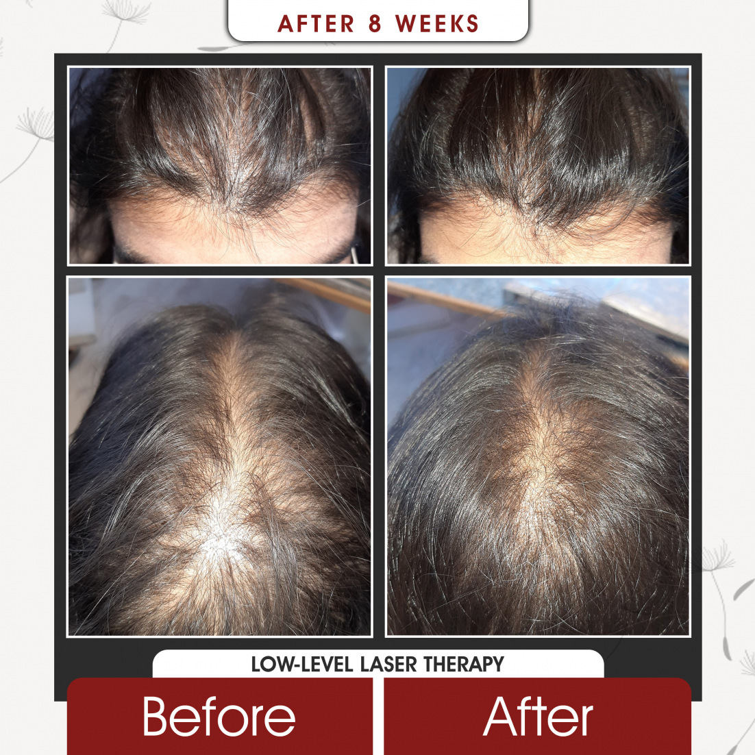 Low Level Laser Therapy After 8 Weeks