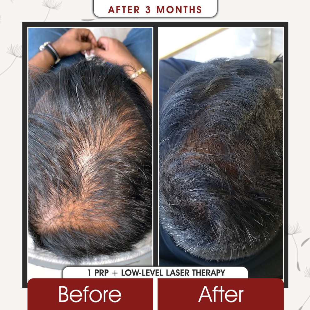 PRP hair restoration procedure for thinning hair