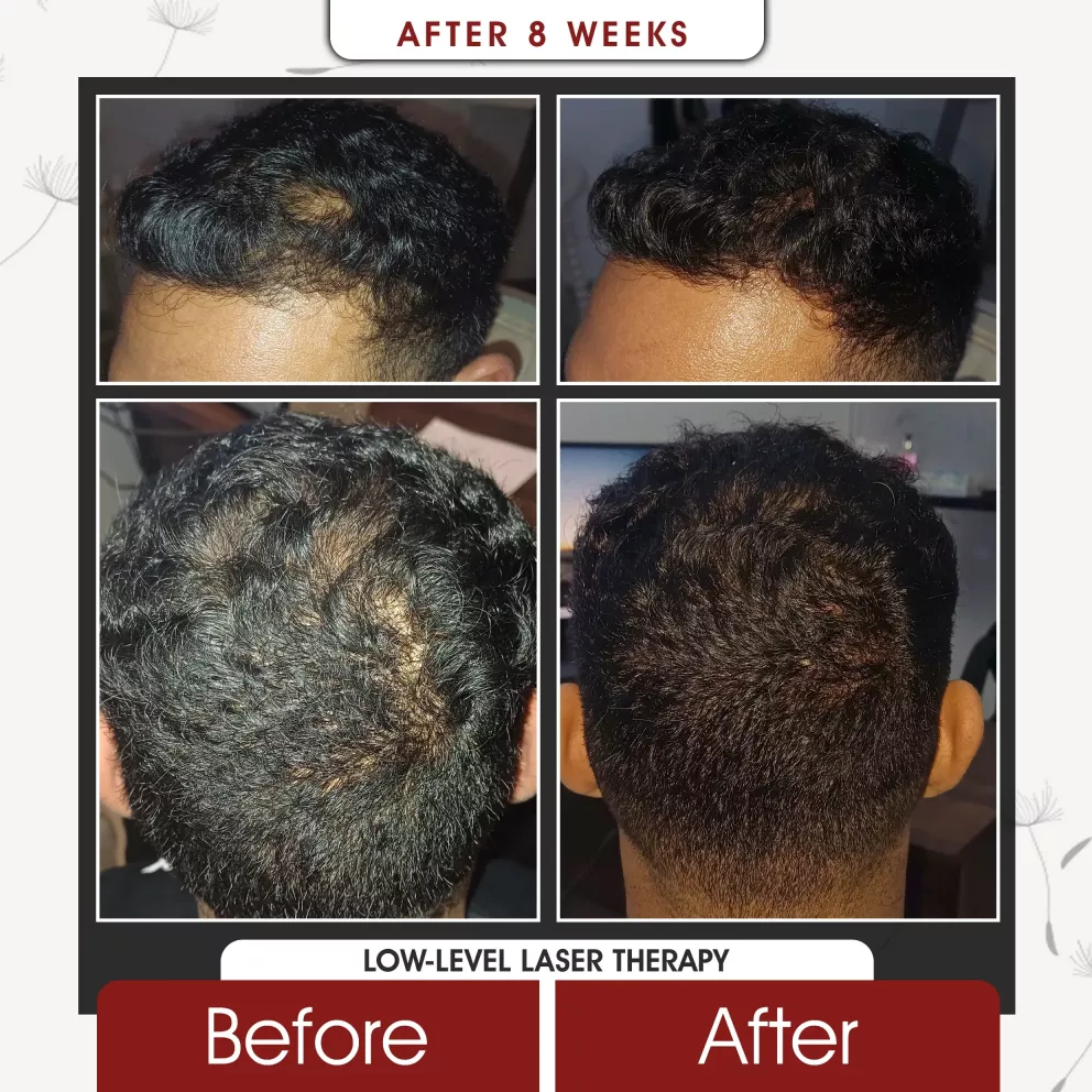 Before and after low level laser therapy for hair loss at Grace Follicles