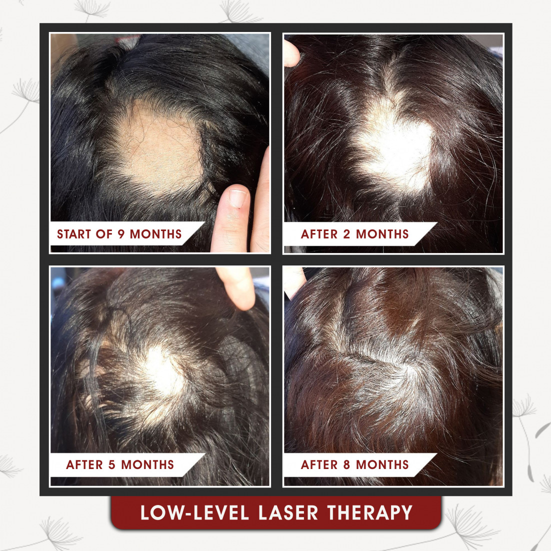 Low Level Laser Therapy