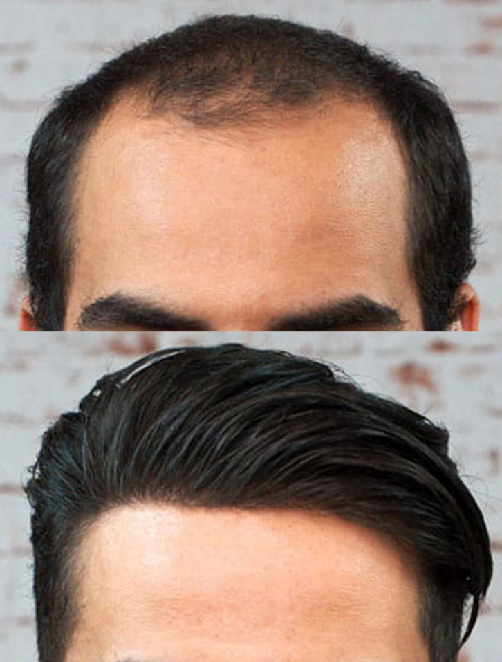 Custom non-surgical hair replacement system