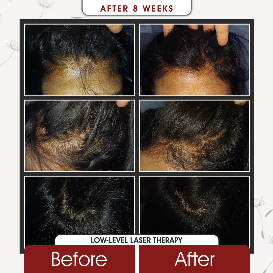 Low Level Laser Therapy After 8 Weeks