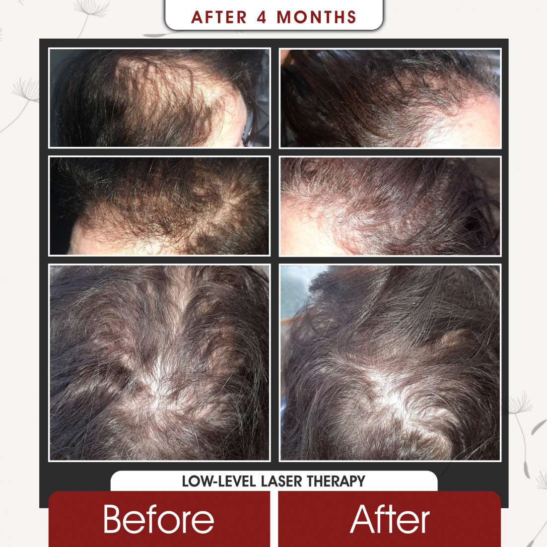 Low Level Laser Therapy After 4 Months