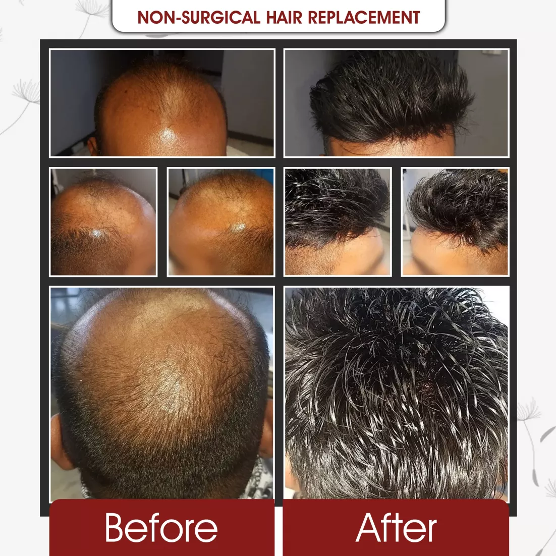 Non Surgical Hair Replcement